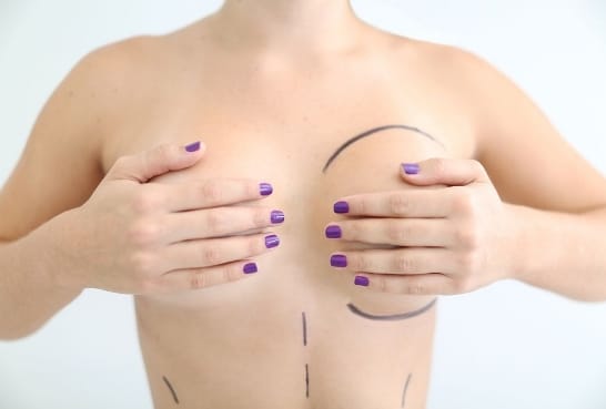 Mastopexy (Breast Lift)